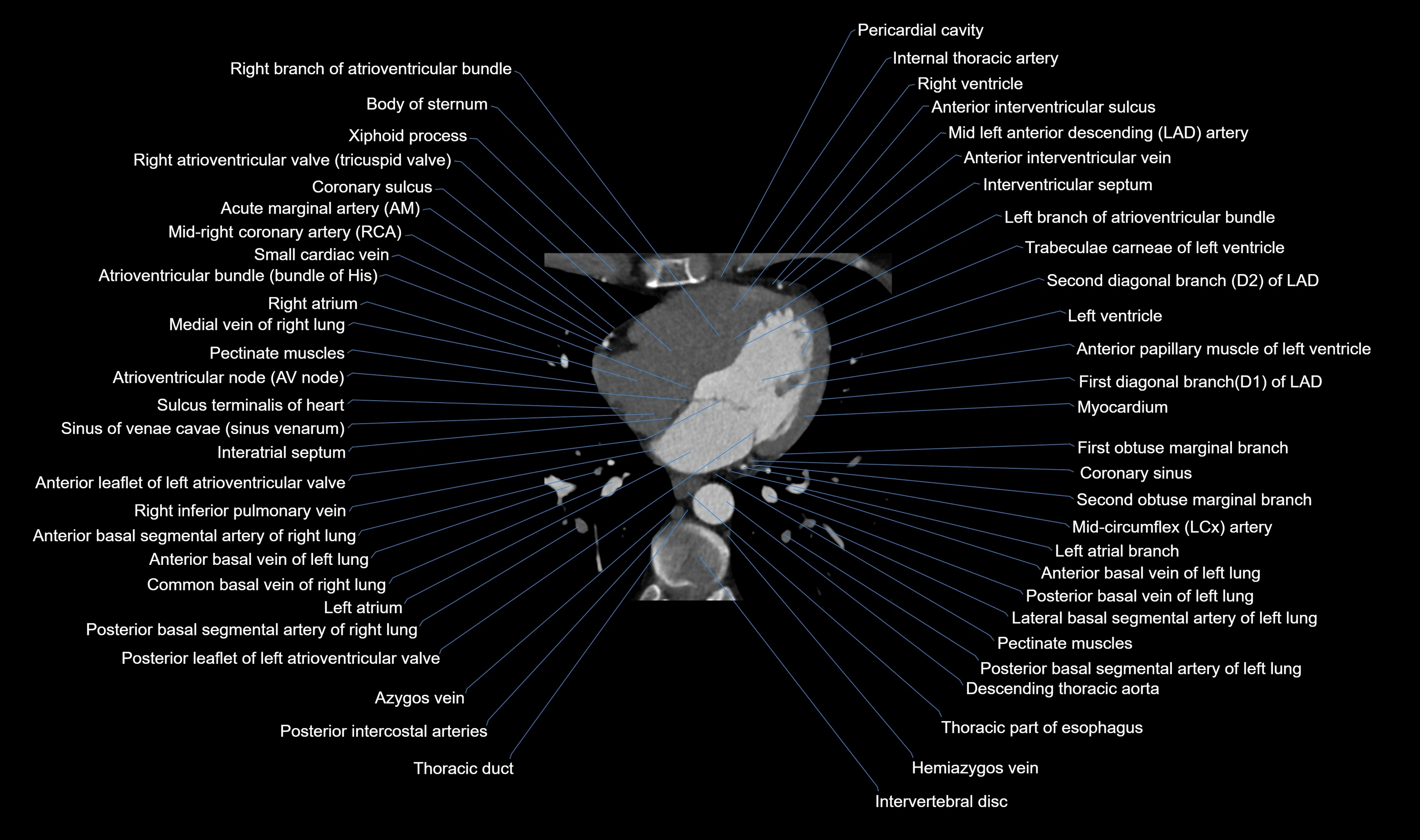 CT heart (coronary angiogram) axial view cross sectional anatomy labelled radiology image-00040.webp